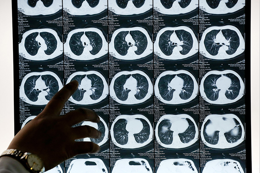 Компьютерная томография больного раком легких


