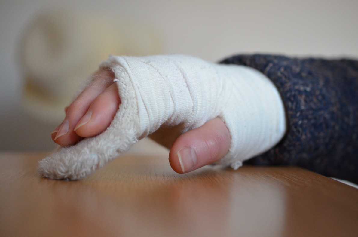 Лечение перелома лучевой кости руки в СПб