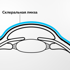 Что делать, если нельзя провести лазерную коррекцию зрения