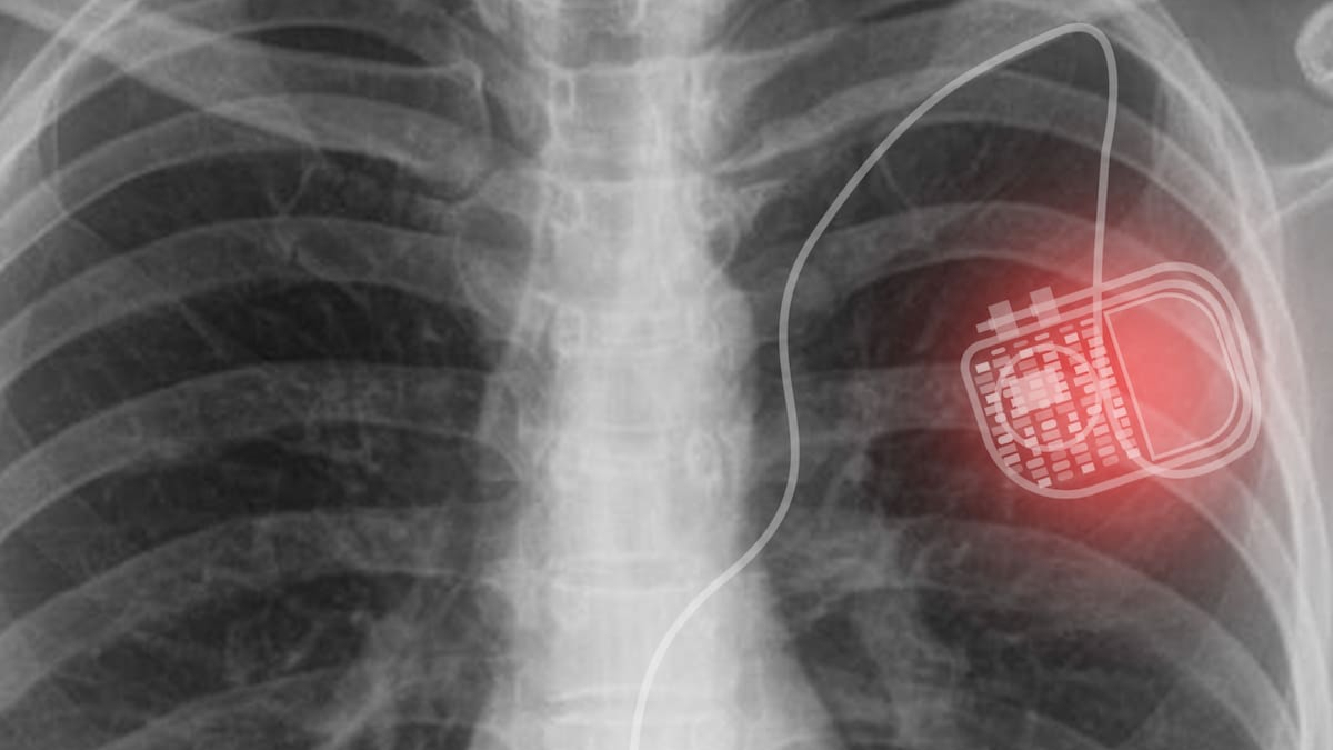 Жизнь с кардиостимулятором: советы пациентам