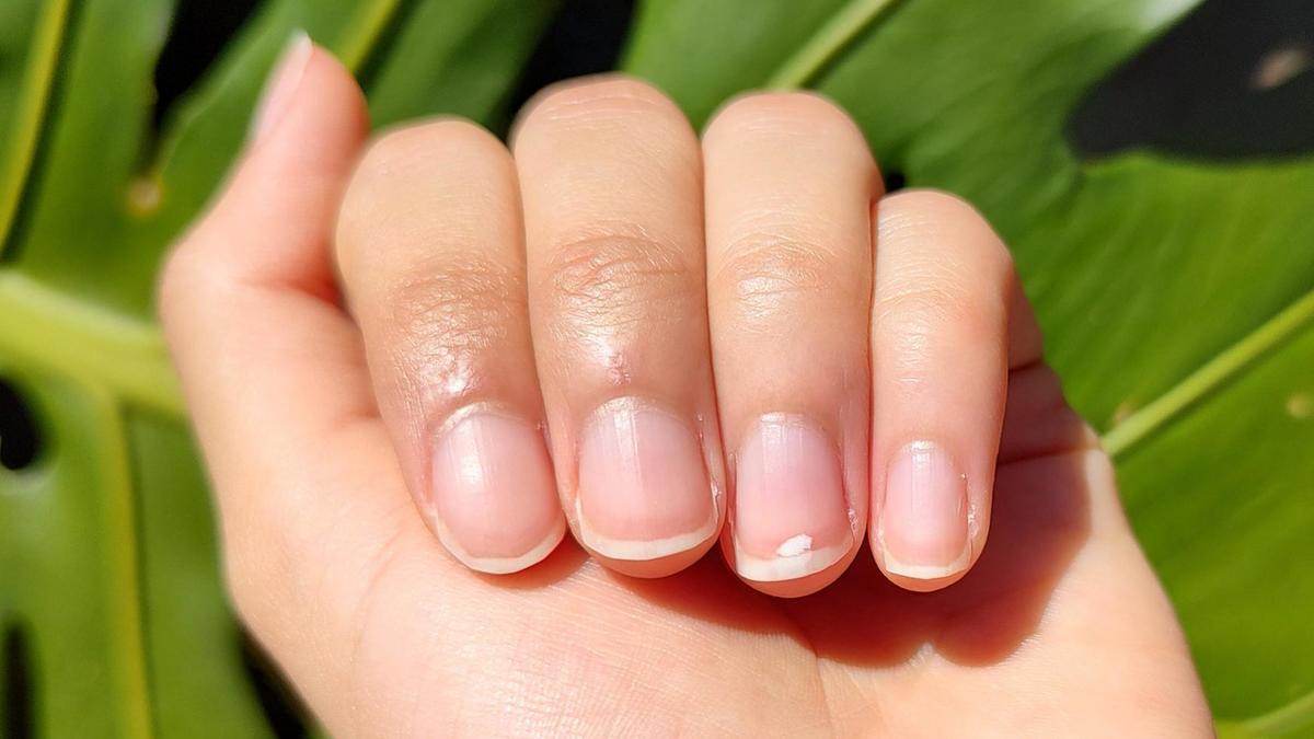 Классификация белых пятен на ногтях