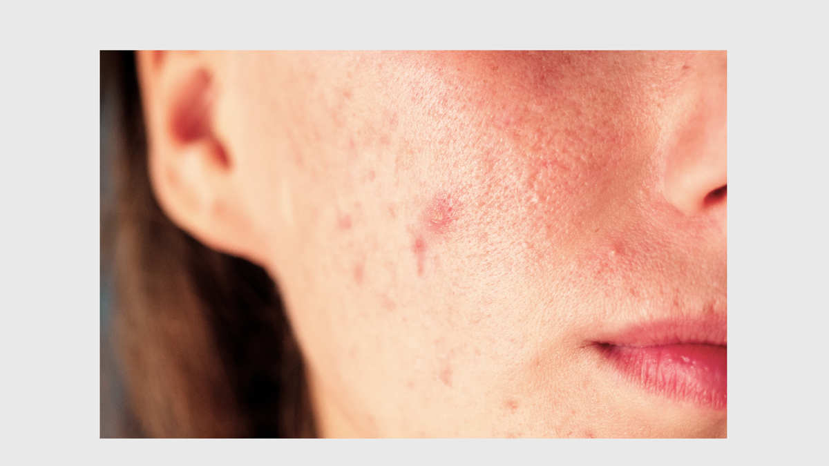 Симптомы шелушения кожи