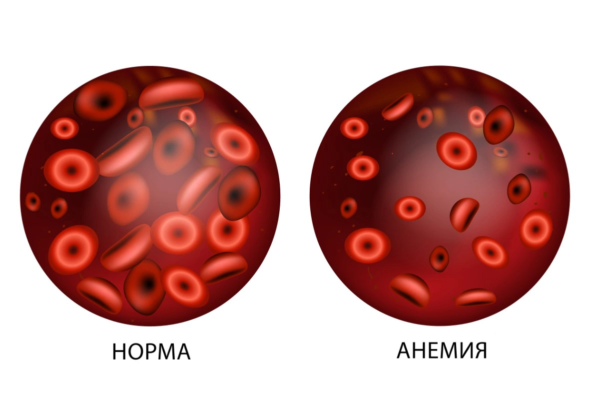 Что такое анемия и как с ней бороться?