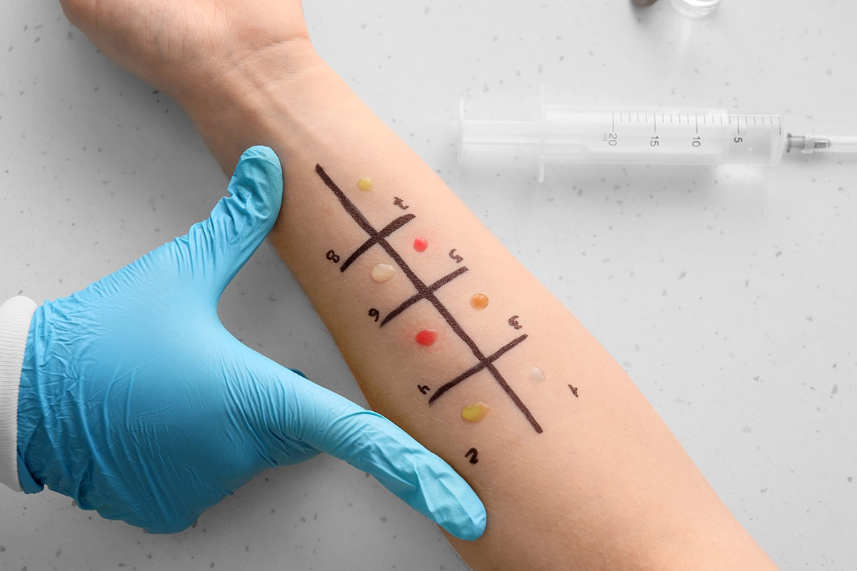 Для того, чтобы наверняка определить, какой именно вид алкоголя будет вызывать у вас аллергическую реакцию, необходимо сделать аллергопробы