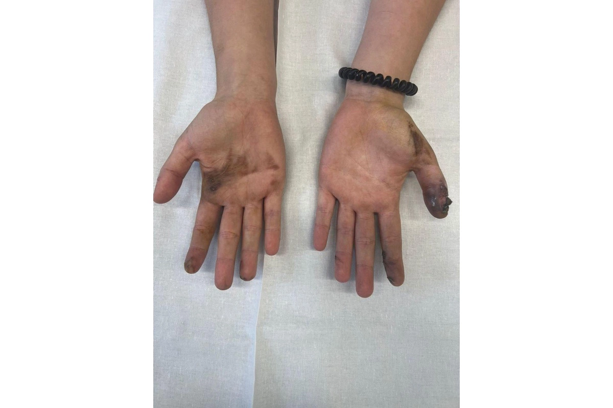 Подмосковные врачи спасли девушку, у которой в руках взорвался телефон