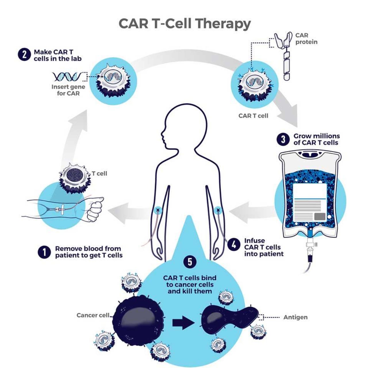 CAR-Т клеточная терапия