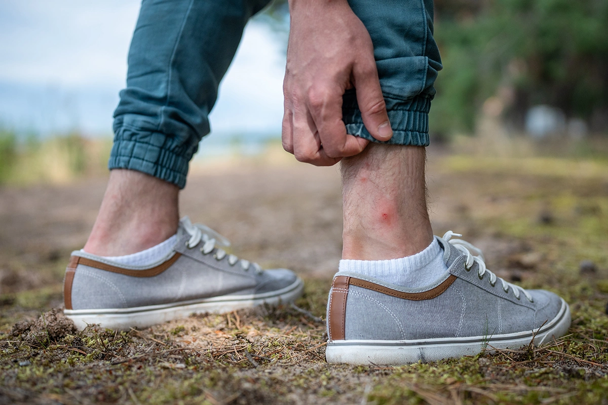 В некоторых случаях укусы мух бывают заразны либо провоцируют аллергические реакции