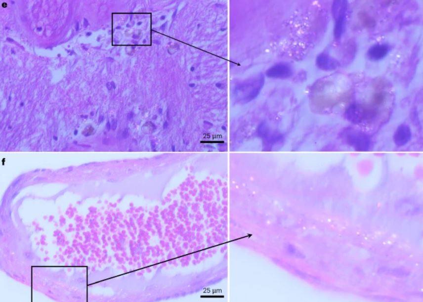 Визуализация скоплений частиц микропластика в мозге человека


