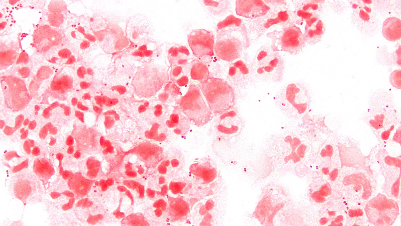 Neisseria meningitidis в спинномозговой жидкости