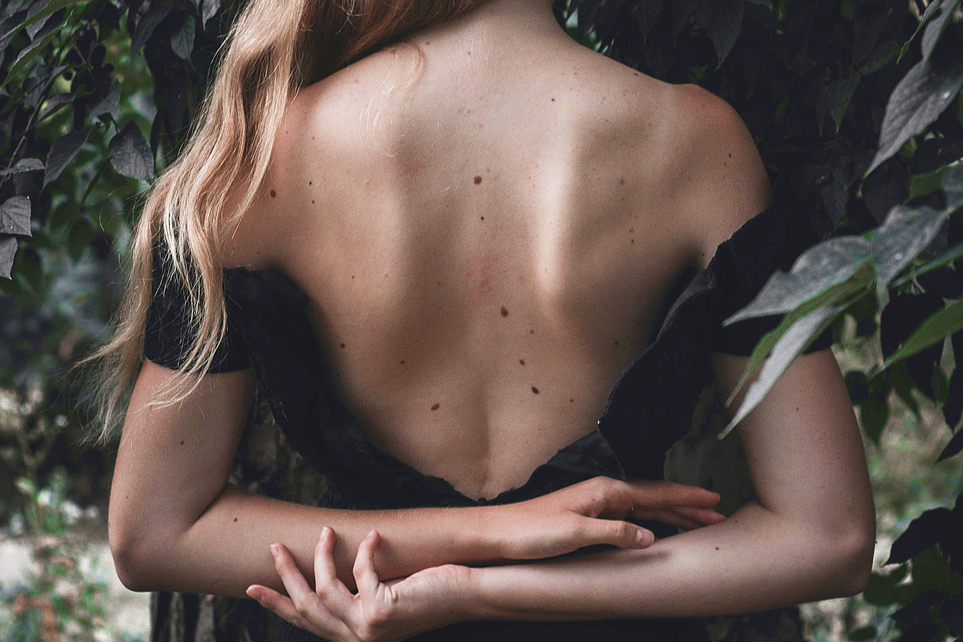 5 ответов на важные вопросы о родинках на нашем теле