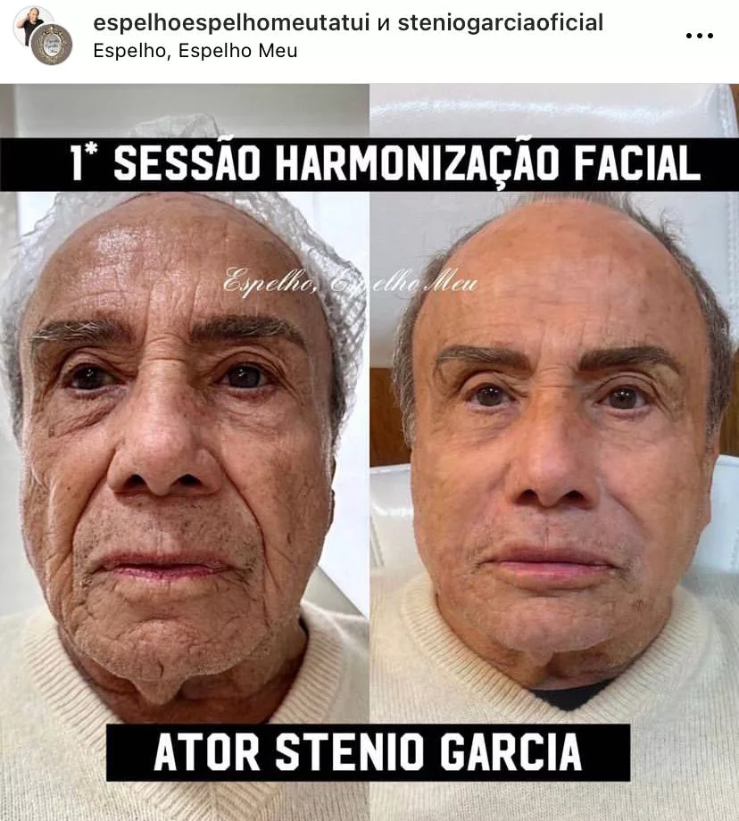 <p>Стенио Гарсиа до и после пластической операции весной 2023 года</p>