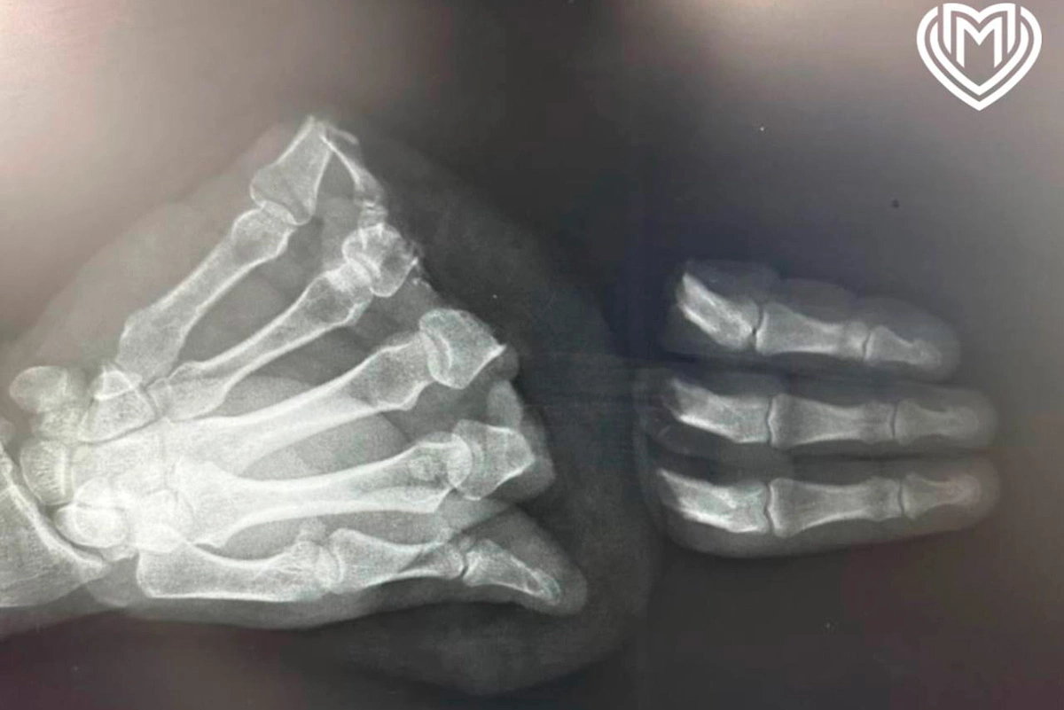 Рентгенгеновский снимок ампутированных пальцев