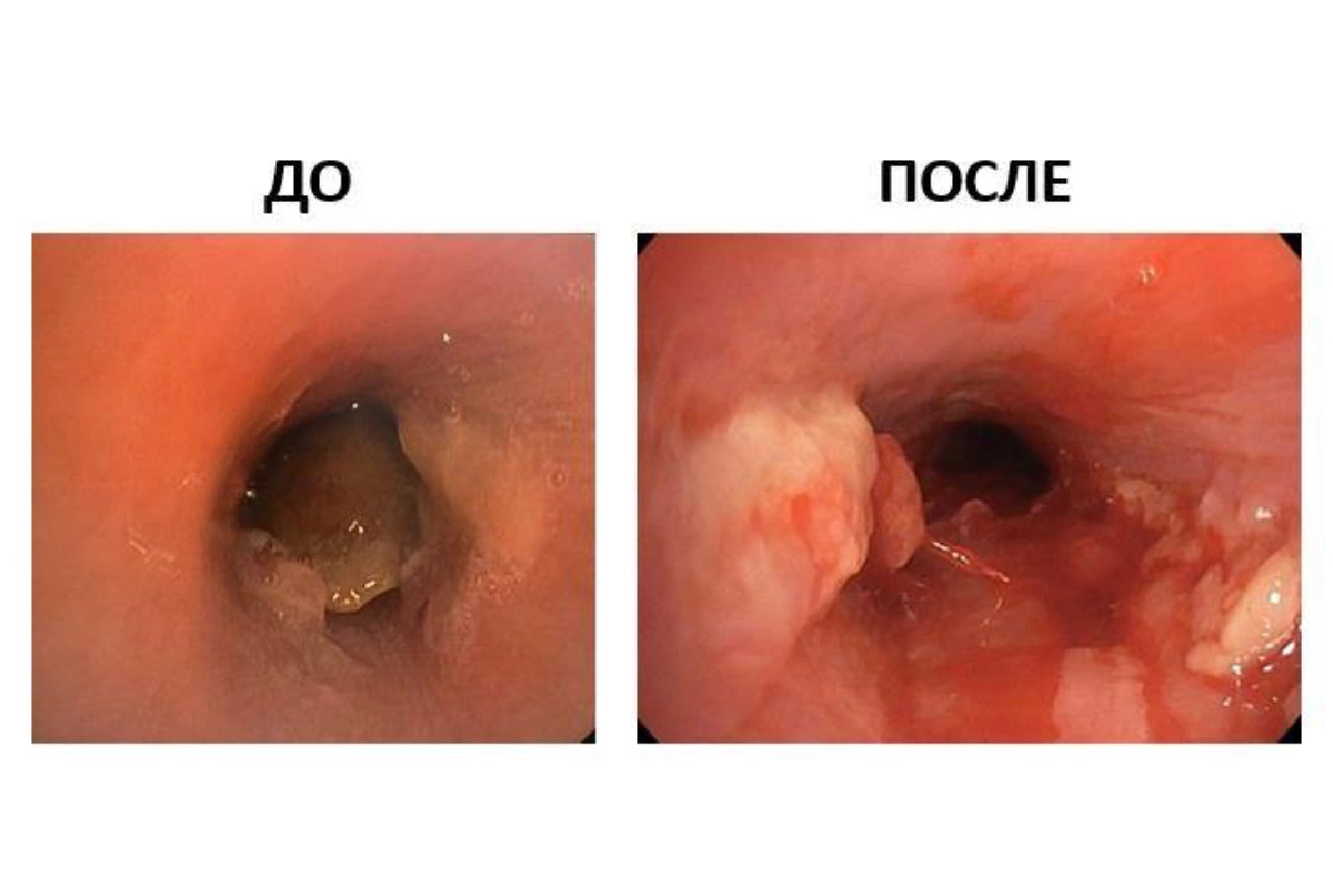 В Центре Рошаля спасли ребенка со скорлупой фисташки в трахее