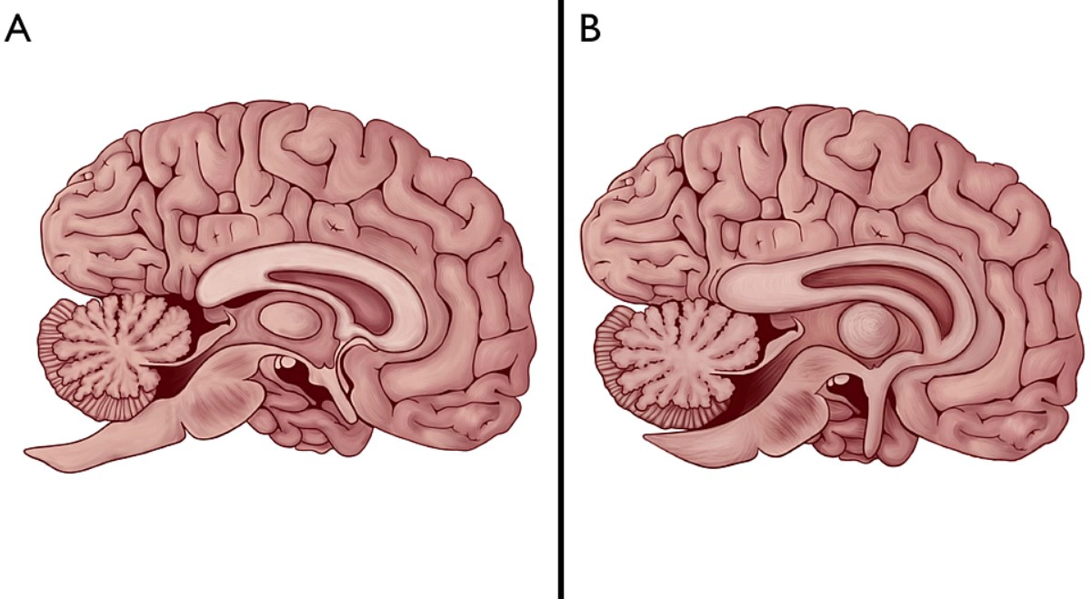 <p>Изображение человеческого мозга в сравнении с тем, как он описывался в древних текстах</p>