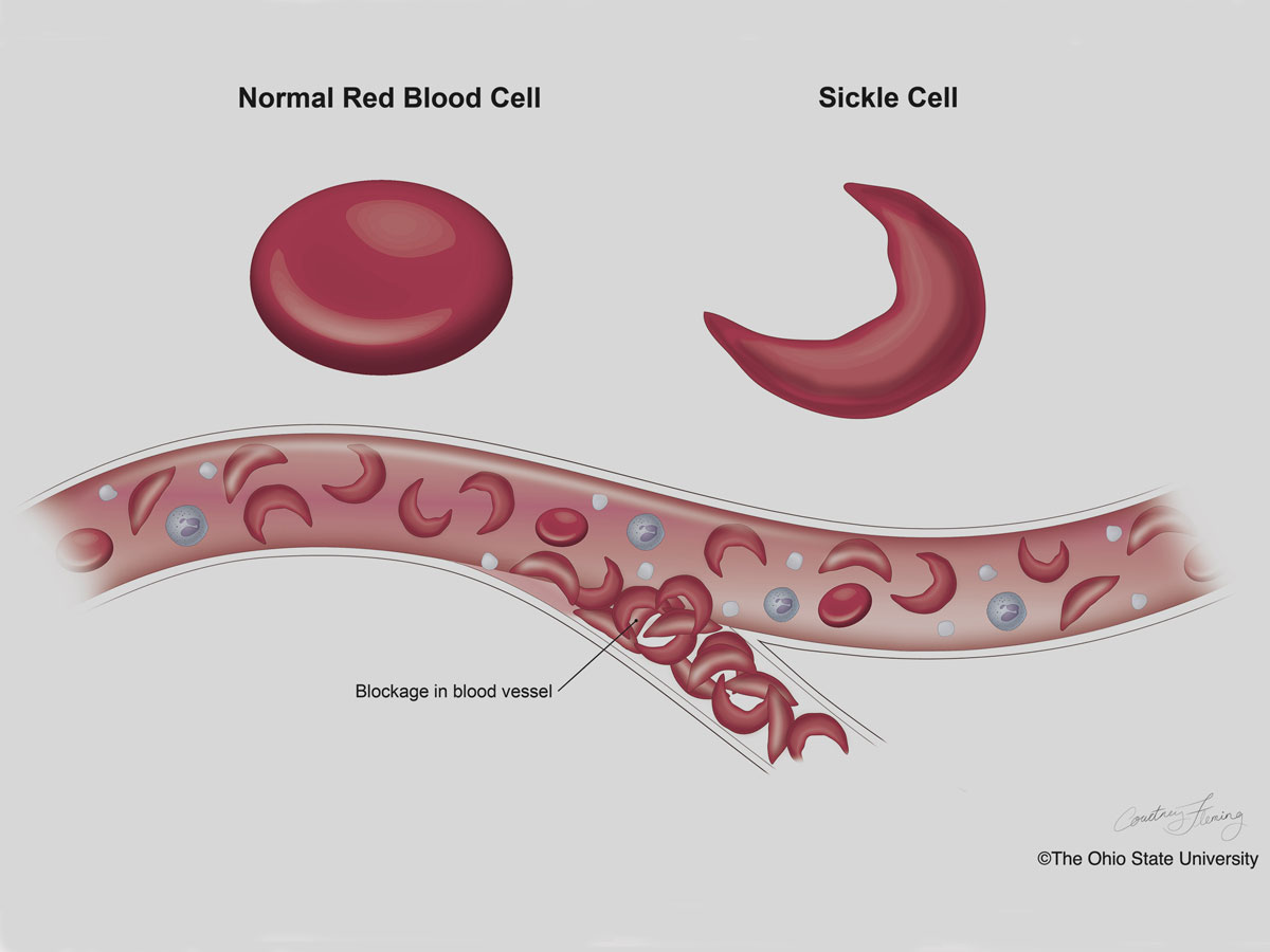 Как выглядит нормальный гемоглобин и какой он при серповидноклеточной анемии.