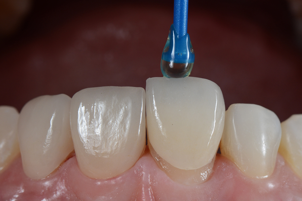 Виниры ставят на передние зубы. Пластина может закрывать видимую часть зуба целиком или отдельный ее участок