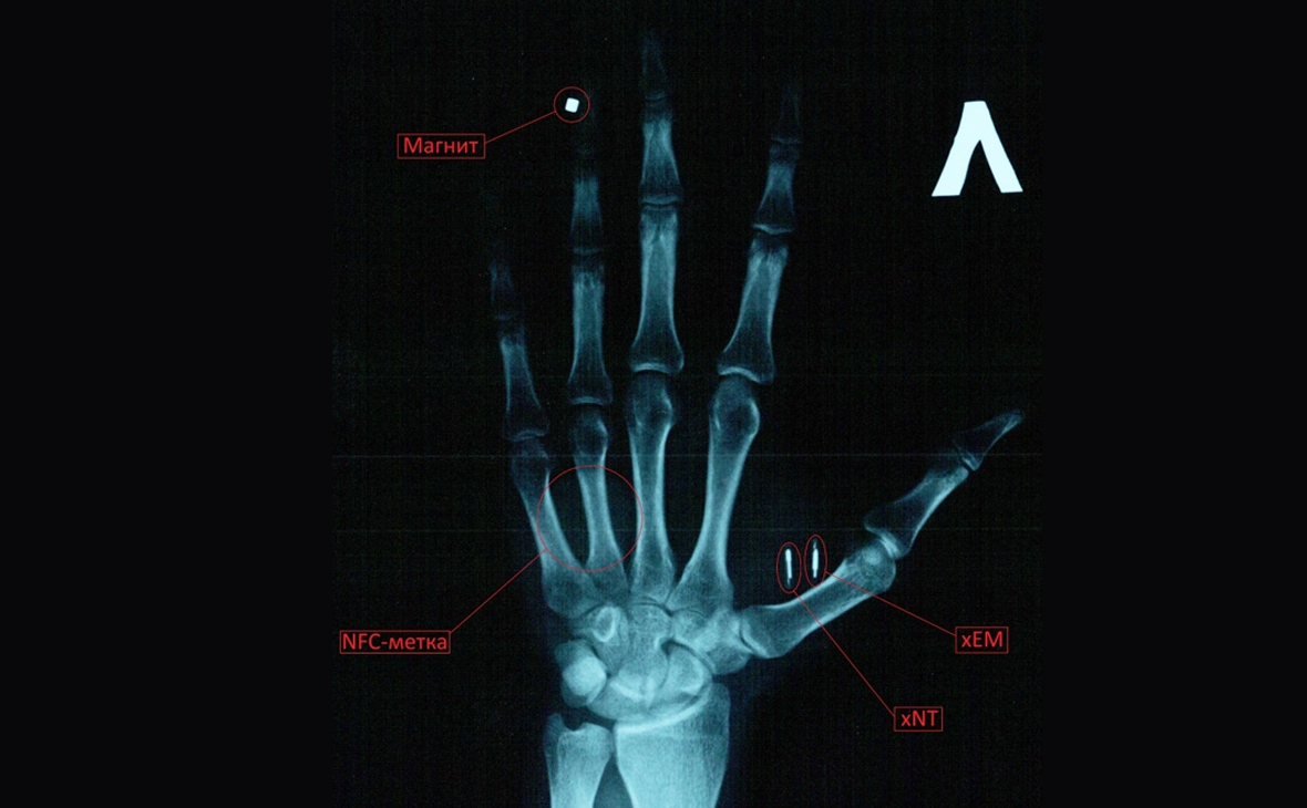 В 2016 году пользователь &laquo;Хабра&raquo; AndrewRo вживил в свою руку четыре импланта, которые помогают открывать дверь и разблокировать телефон