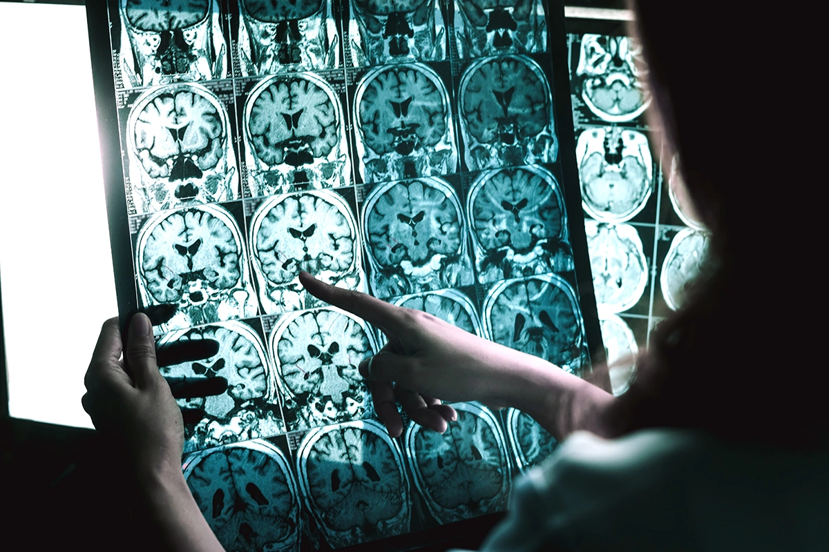 <p>Болезнь Альцгеймера на МРТ</p>