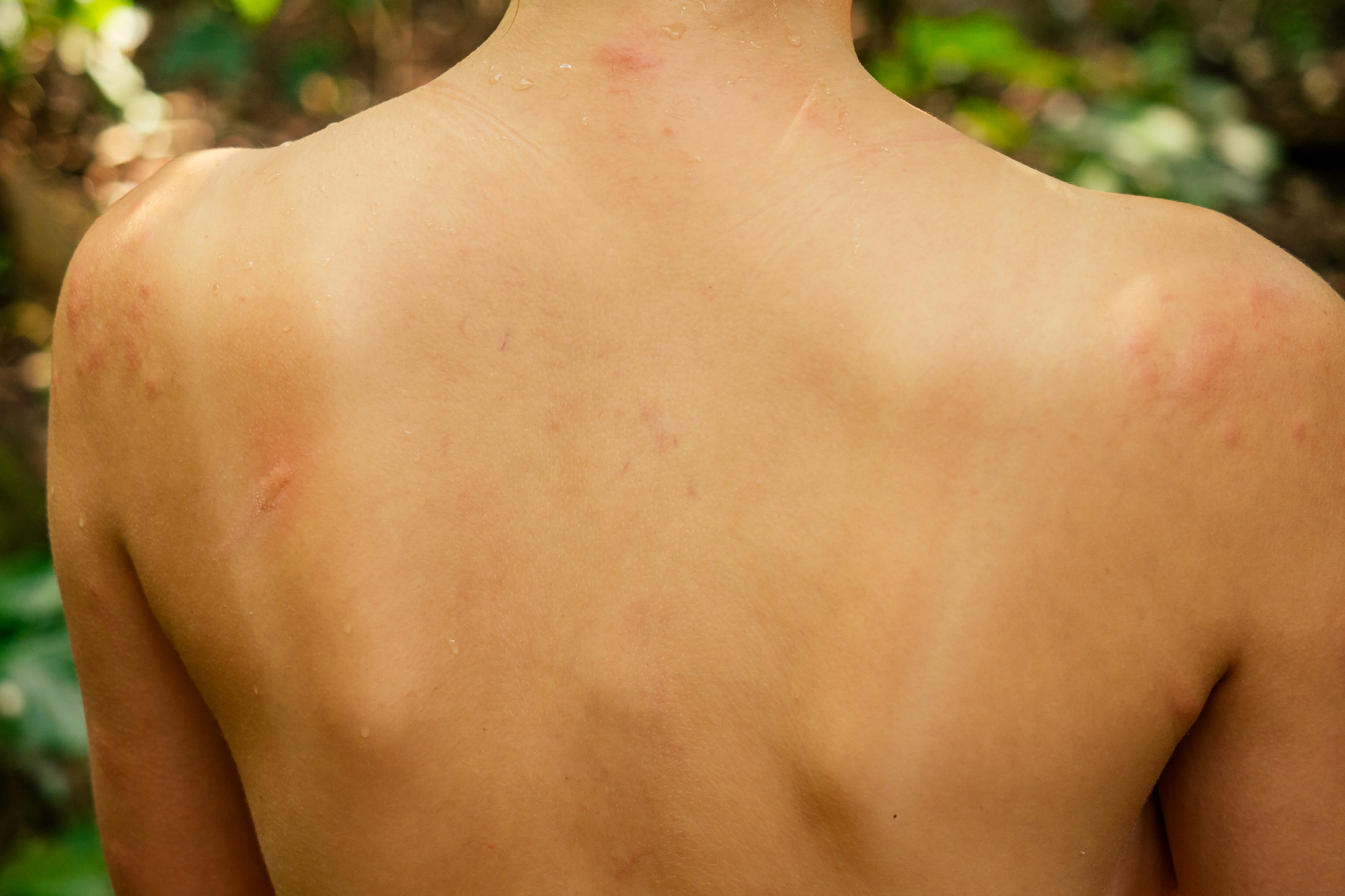 К распространенным признакам аллергии на солнце относятся покраснение и зуд пораженных участков кожи