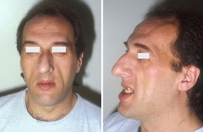 Пациент с акромегалией. При этом заболевании увеличиваются выступающие части лица: надбровные дуги, нос, подбородок, скуловые кости

