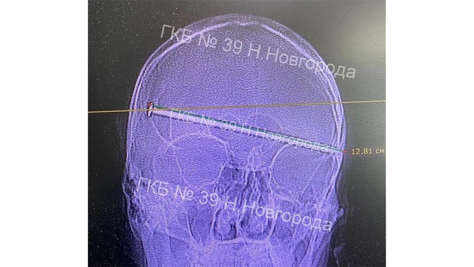 Врачи спасли мужчину с 12-сантиметровым гвоздем в голове