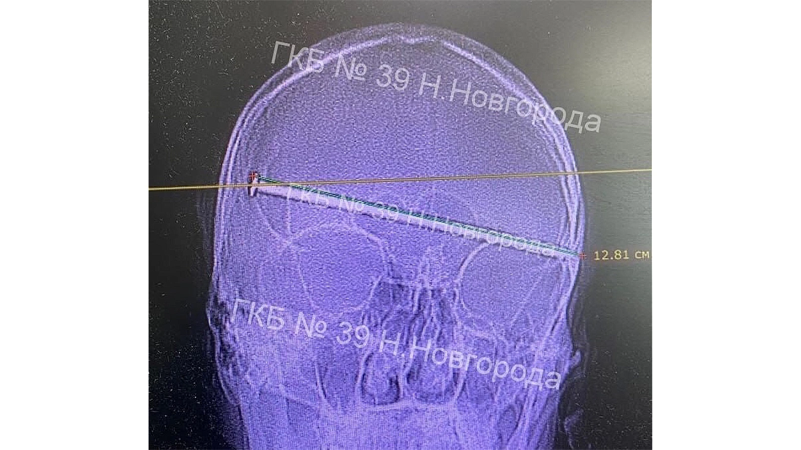 Врачи спасли мужчину с 12-сантиметровым гвоздем в голове