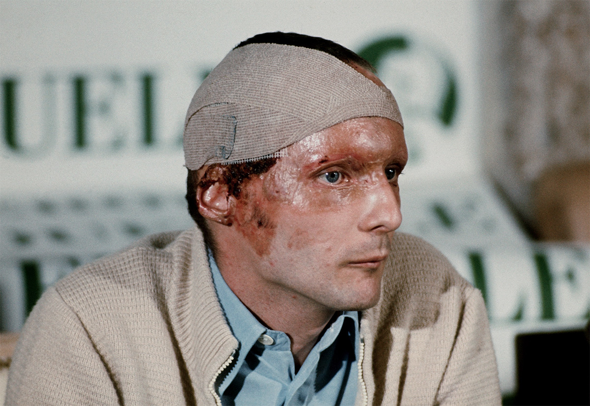 Австрийский гонщик &laquo;Формулы-1&raquo; Ники Лауда со шрамами на лице, повязкой на голове и ожогами во время пресс-конференции в Зальцбурге 8 сентября 1976 года. Лауда, получивший серьезные травмы в результате аварии на &laquo;Нюрбургринге&raquo; 1 августа 1976 года, объявил, что он готов снова водить машину после выздоровления