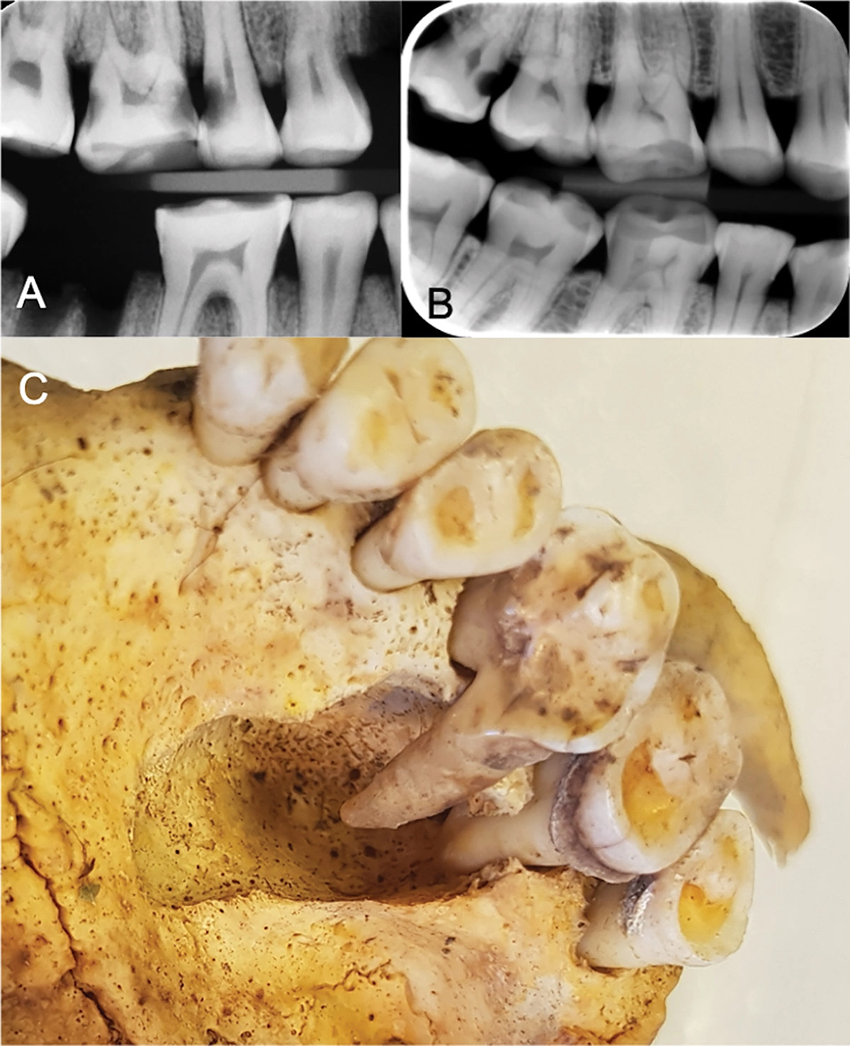 <p>A и B &mdash; кариозные поражения на зубах; C &mdash;&nbsp;поражение коренного зуба, вероятно, киста</p>