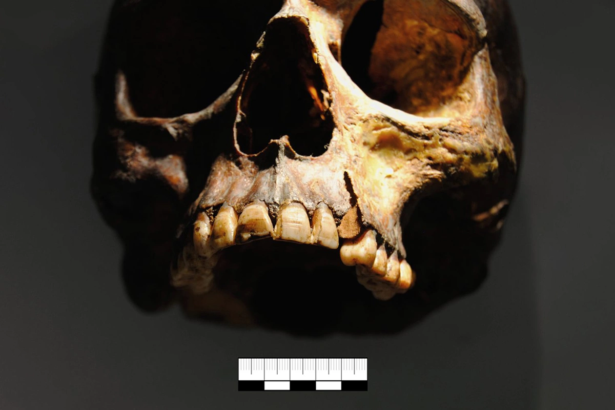 <p>Известно, что викинги наносили насечки на зубы. Однако о том, что они модифицировали форму черепа, раньше не знали</p>