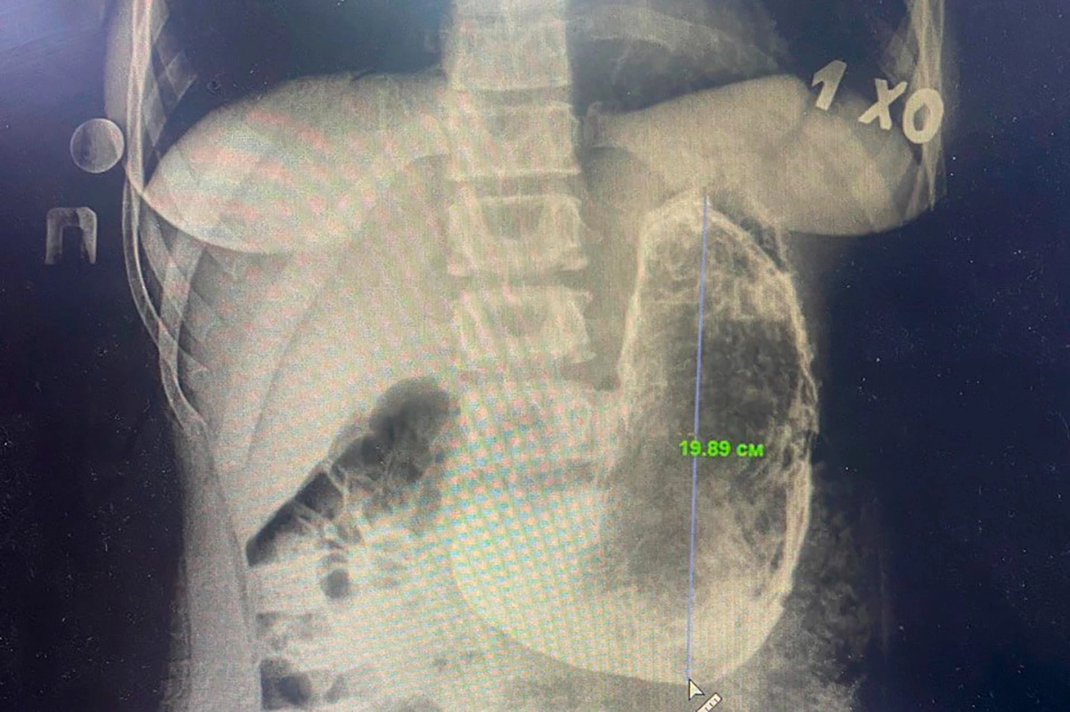 Крупное новообразование в желудке 19-летней девушки