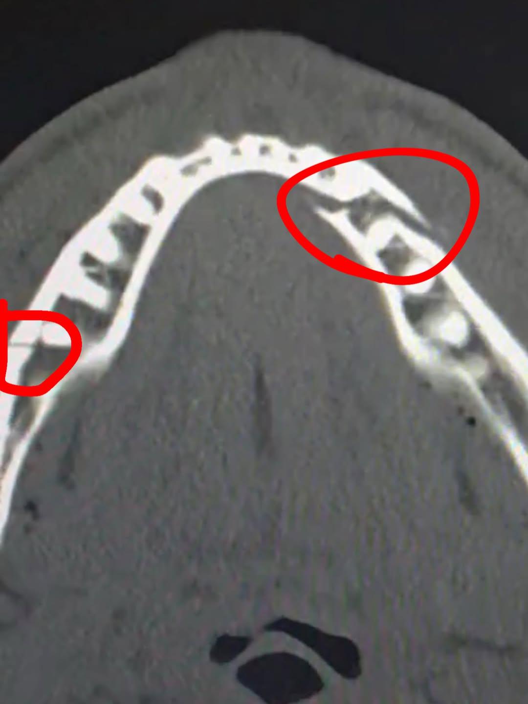 Джейк Пол получил двойной перелом челюсти в бою с Энтони Джошуа