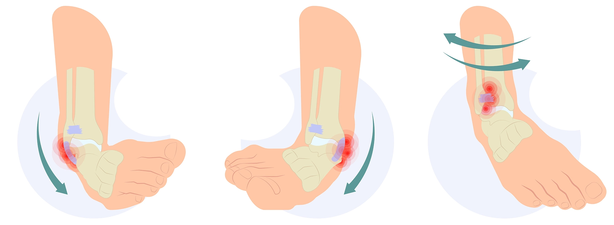 Чаще всего при подворачивании ноги страдают связки, но можно получить и перелом
