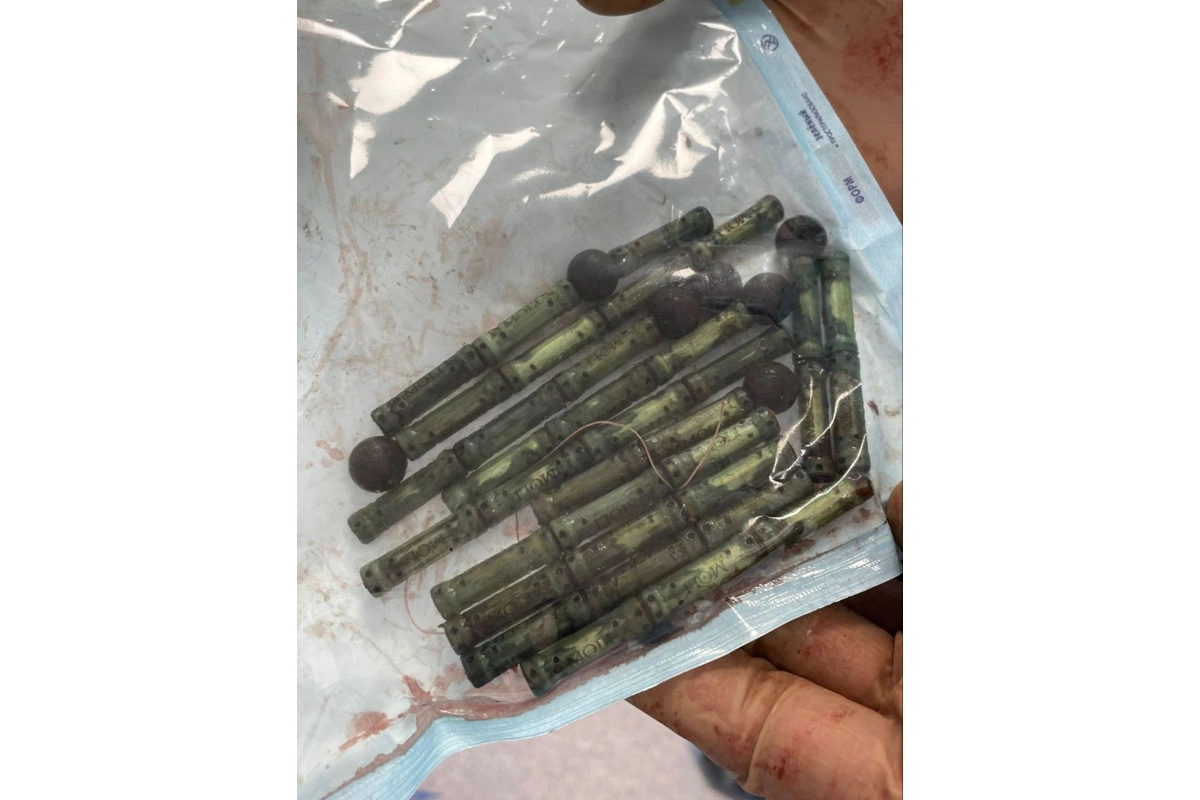 Во Владивостоке из желудка юноши извлекли магнитный конструктор на 420 г