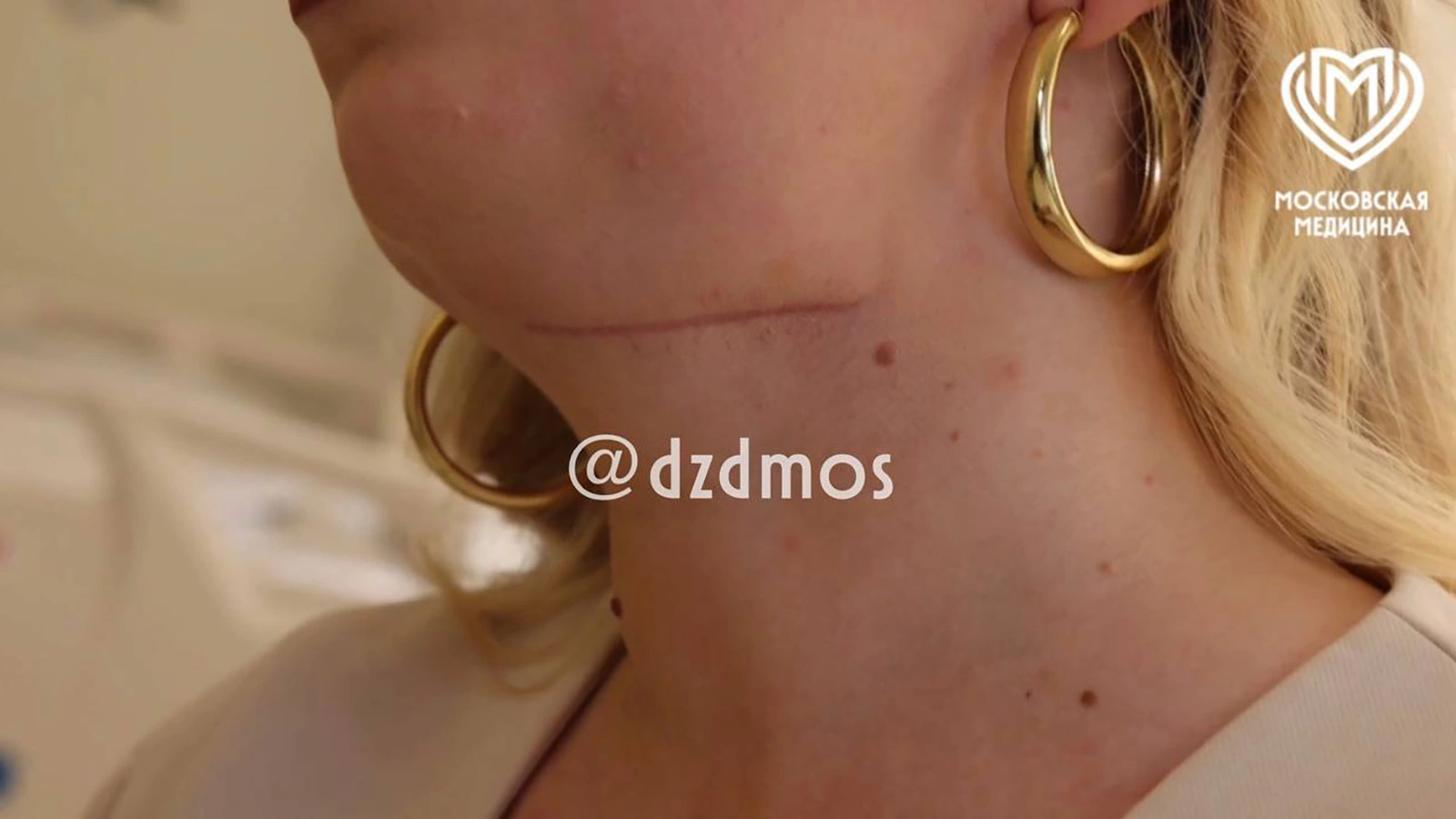 В Москве спасли пациентку из-за осложнений после удаления зубов мудрости