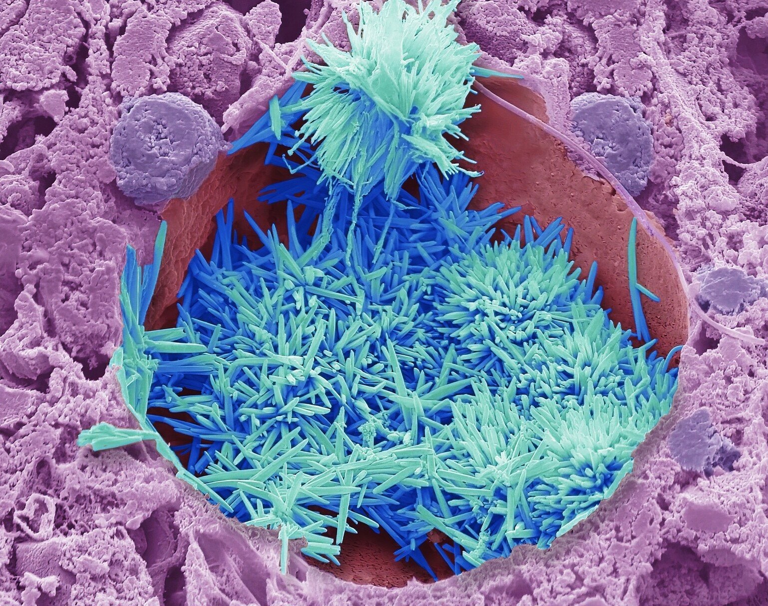 Холестерин в печени