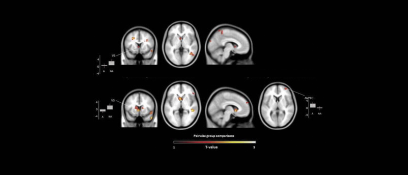 Результаты сканирования мозга во время наблюдения за активностью допаминовой системы вознаграждения в мозге художников