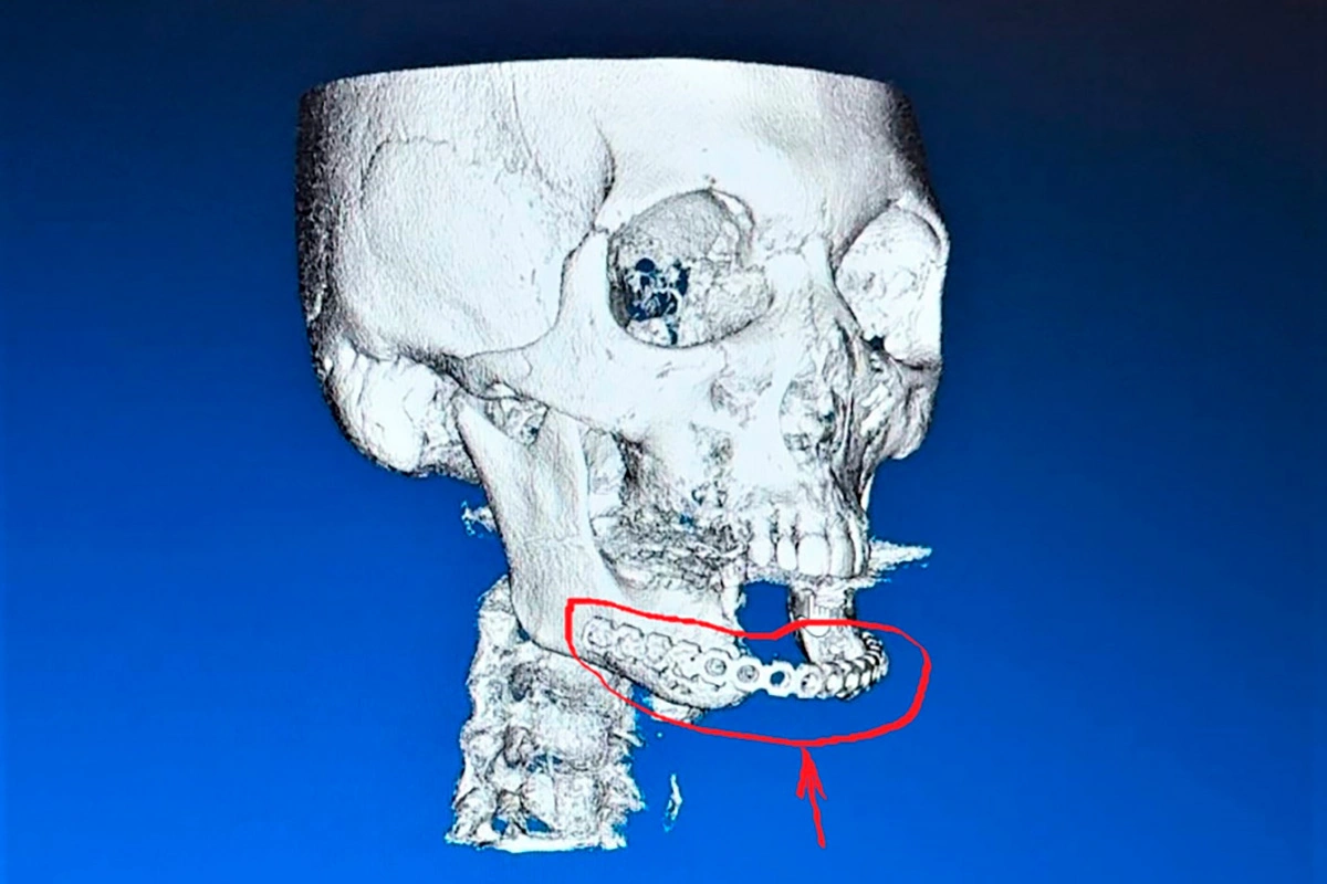 3D-модель челюсти