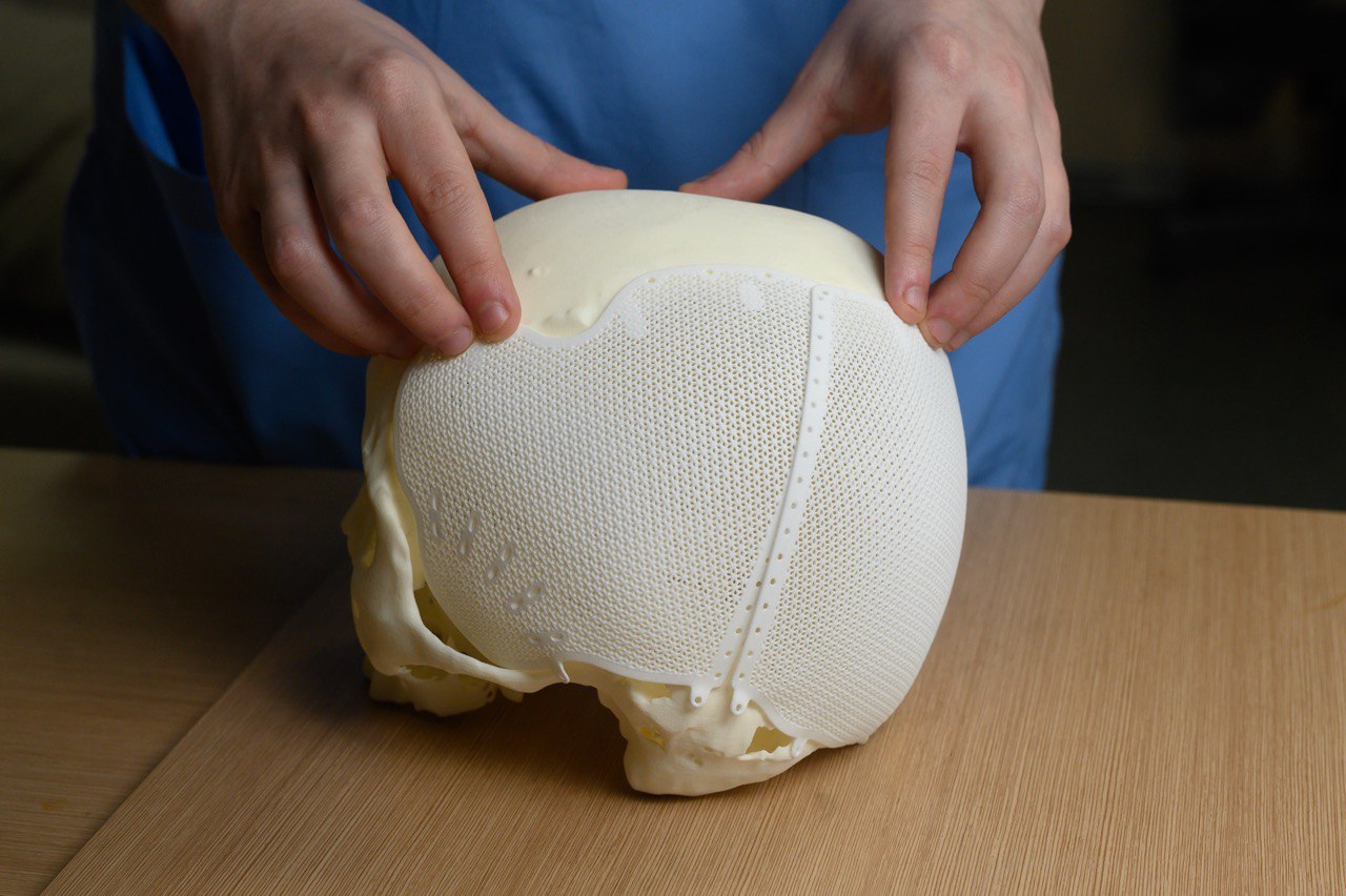 Нейросети в Новосибирском НИИТО задействуют для подготовки индивидуальных 3D-имплантатов для костей черепа.