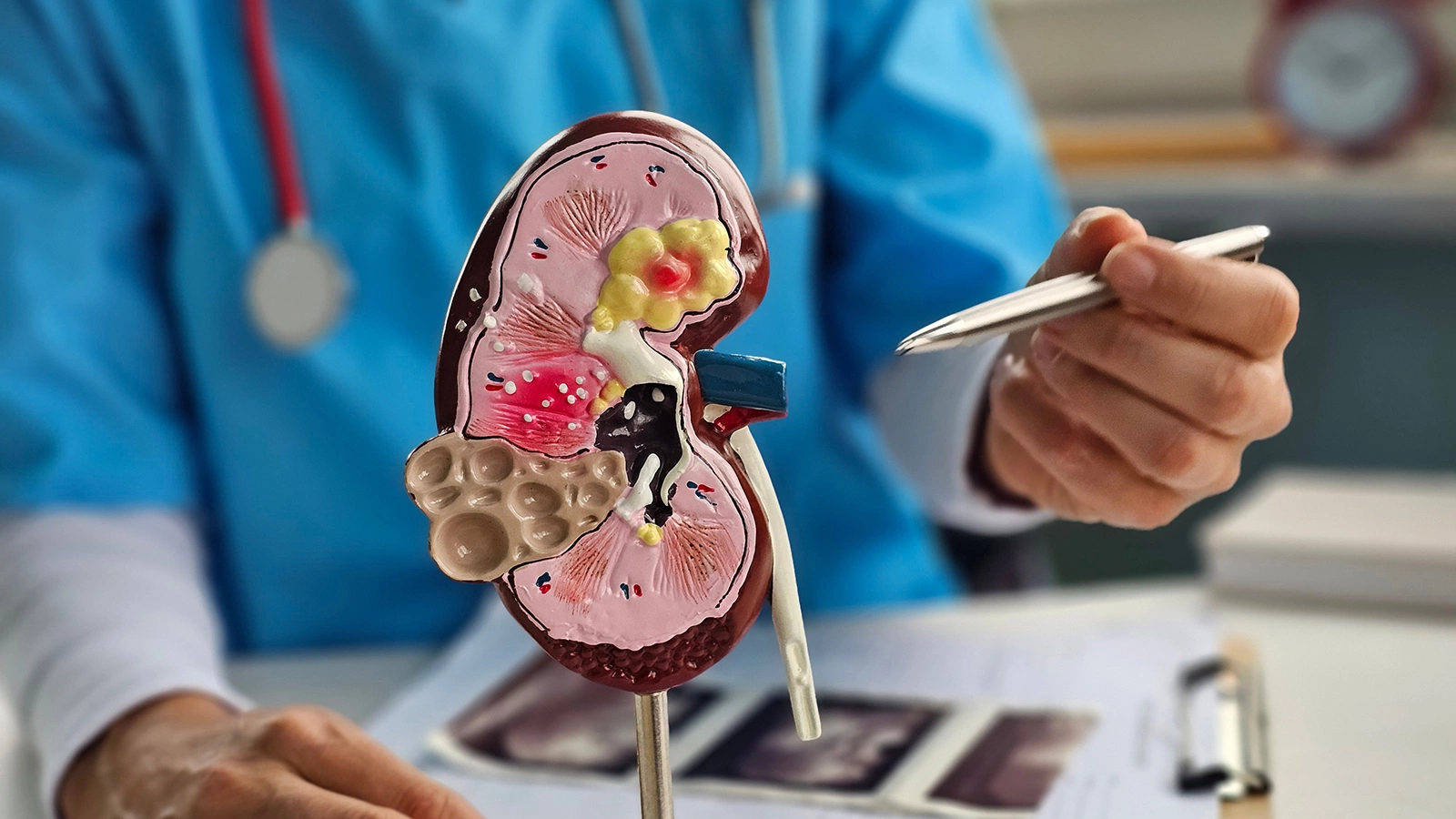 Врач перечислила симптомы рака почки