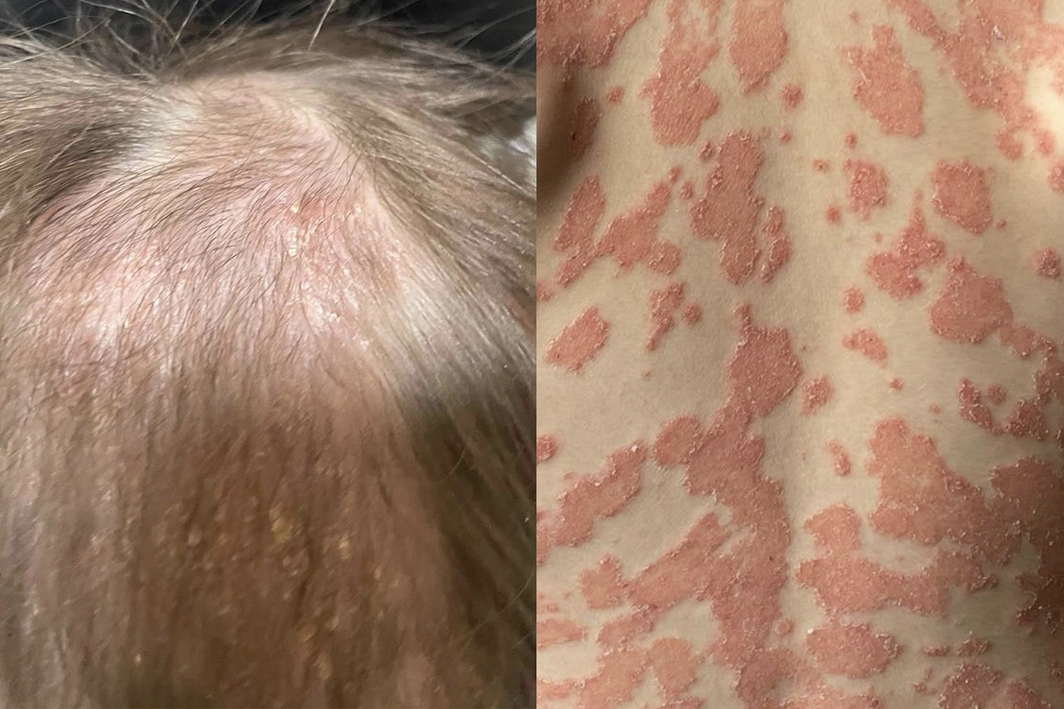 В Подмосковье спасли годовалого ребенка с тяжелой формой псориаза