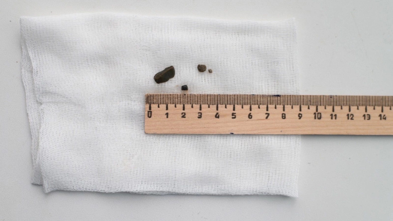 Во Владивостоке спасли 4-летнюю девочку, проглотившую камни