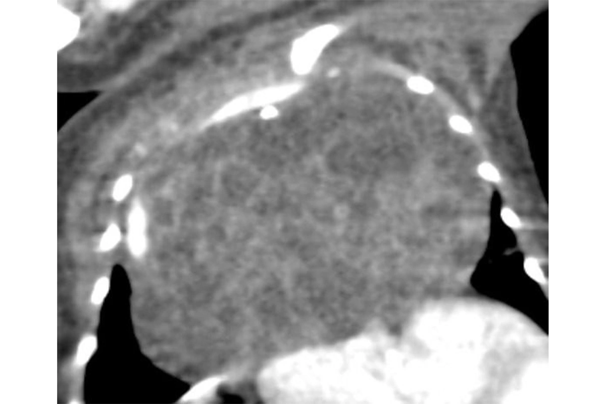 Опухоль у младенца на рентгеновском снимке