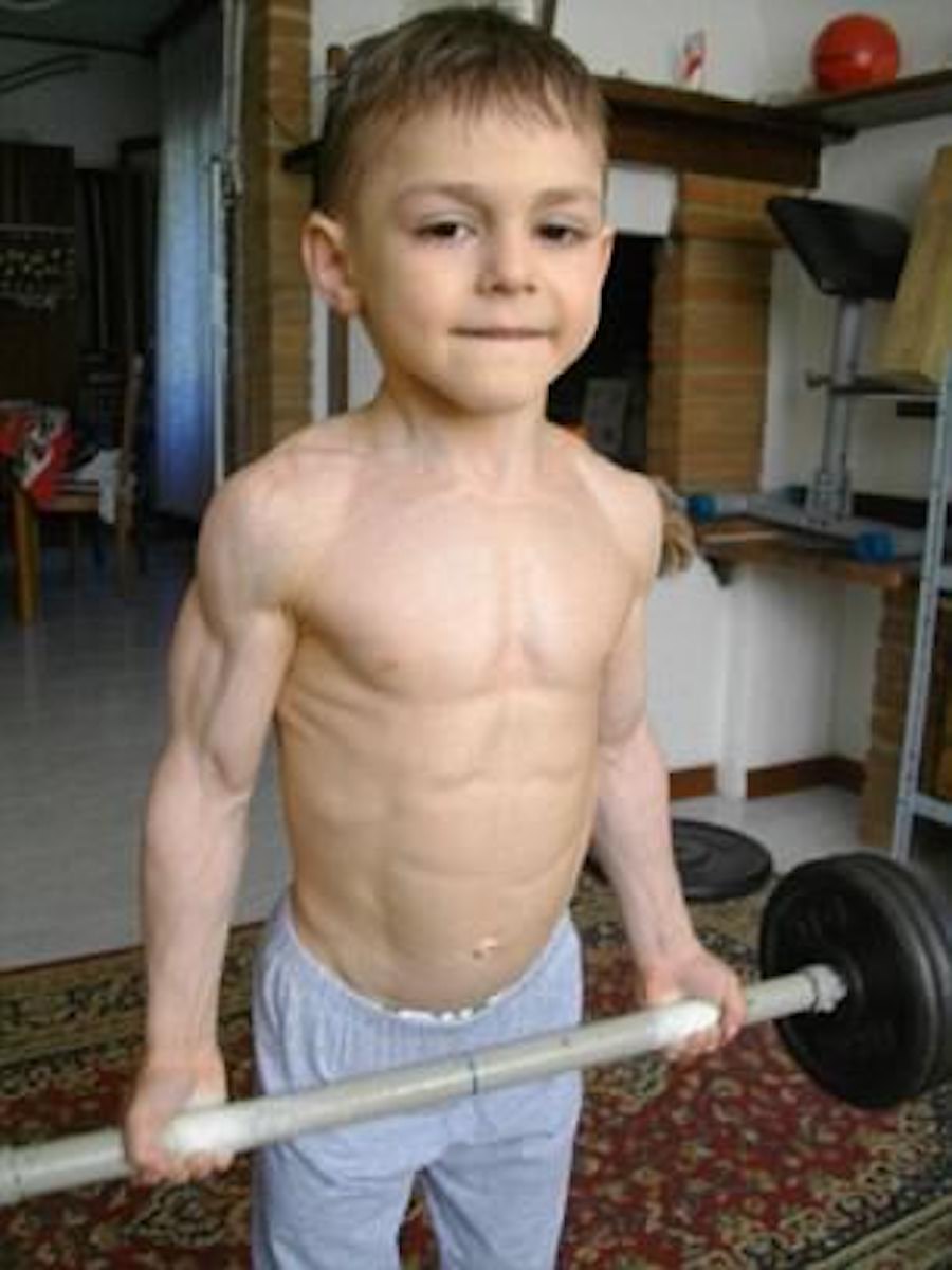 На фото Лиам Хекстра, которого гипертрофия мышц, связанная с миостатином, сделала очень мускулистыми