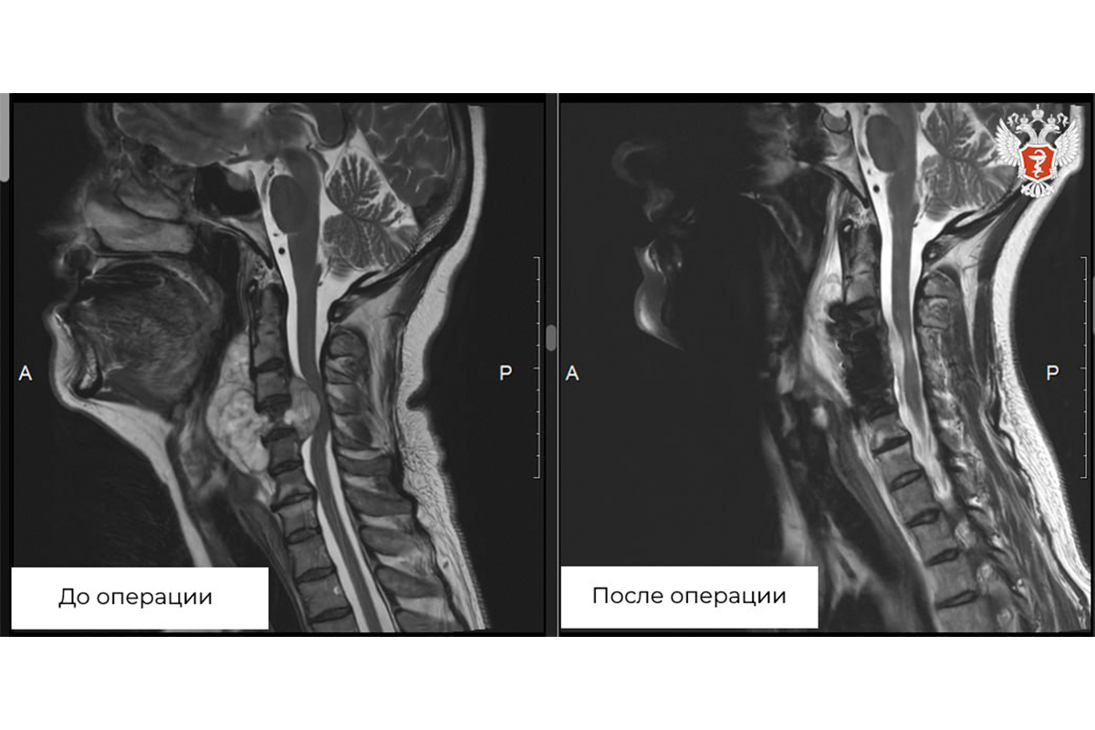 Образование в шейном отделе позвоночника пациентки