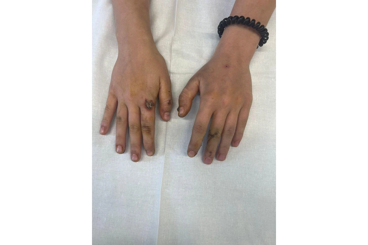 Подмосковные врачи спасли девушку, у которой в руках взорвался телефон