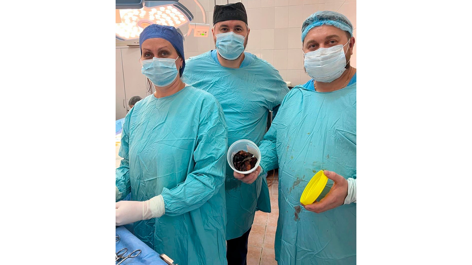 Крупное новообразование, извлеченное из желудка 19-летней девушки