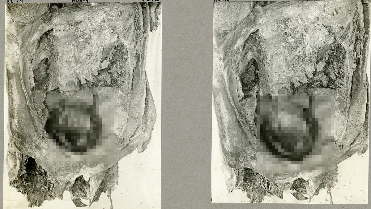 <p>На компьютерной томографии видна голова младенца, вероятно, случайно получившего смертельную травму во время родов</p>