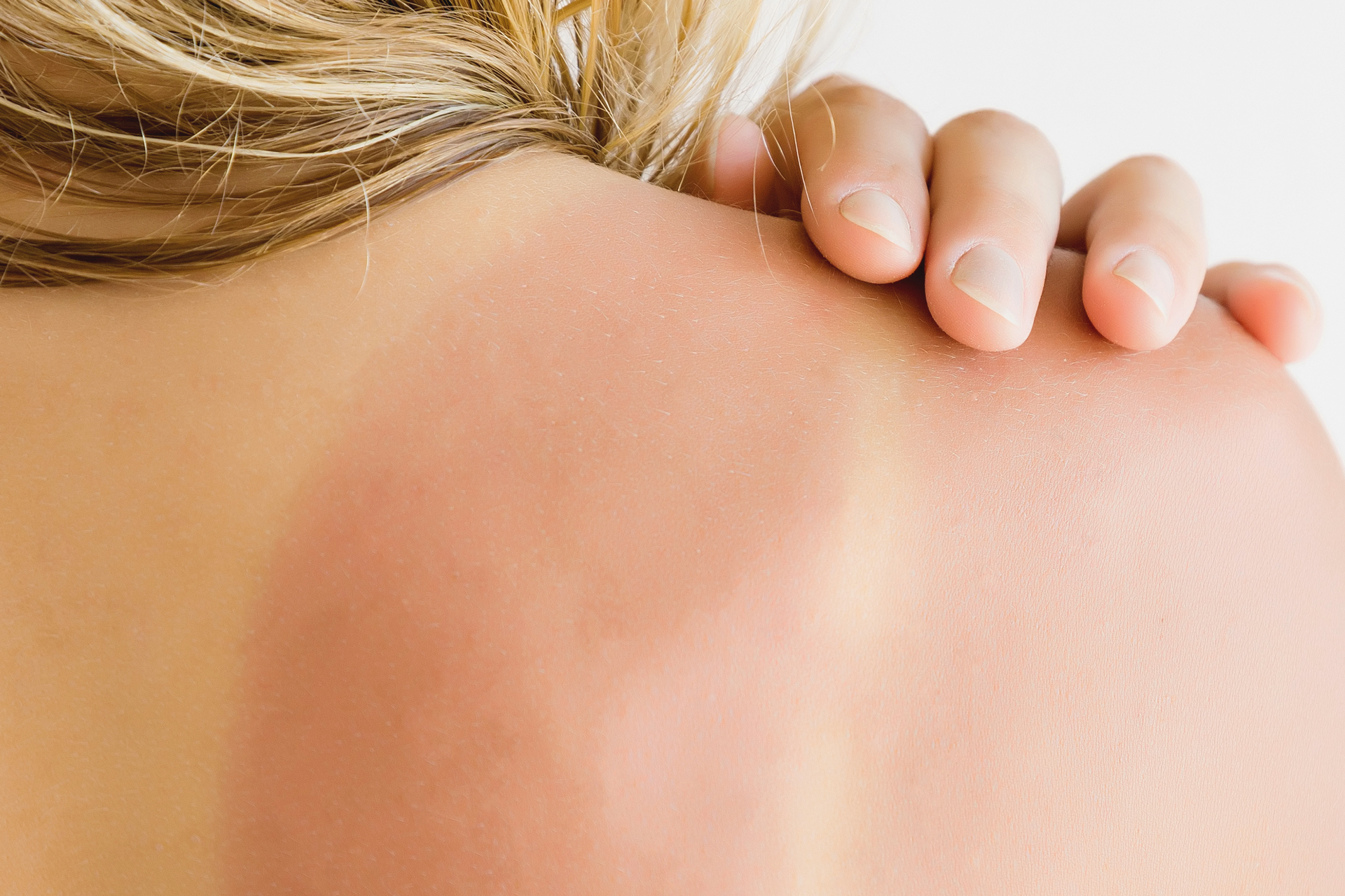Профилактика аллергии на солнце &mdash; защита от раздражителя с помощью кремов, одежды и очков