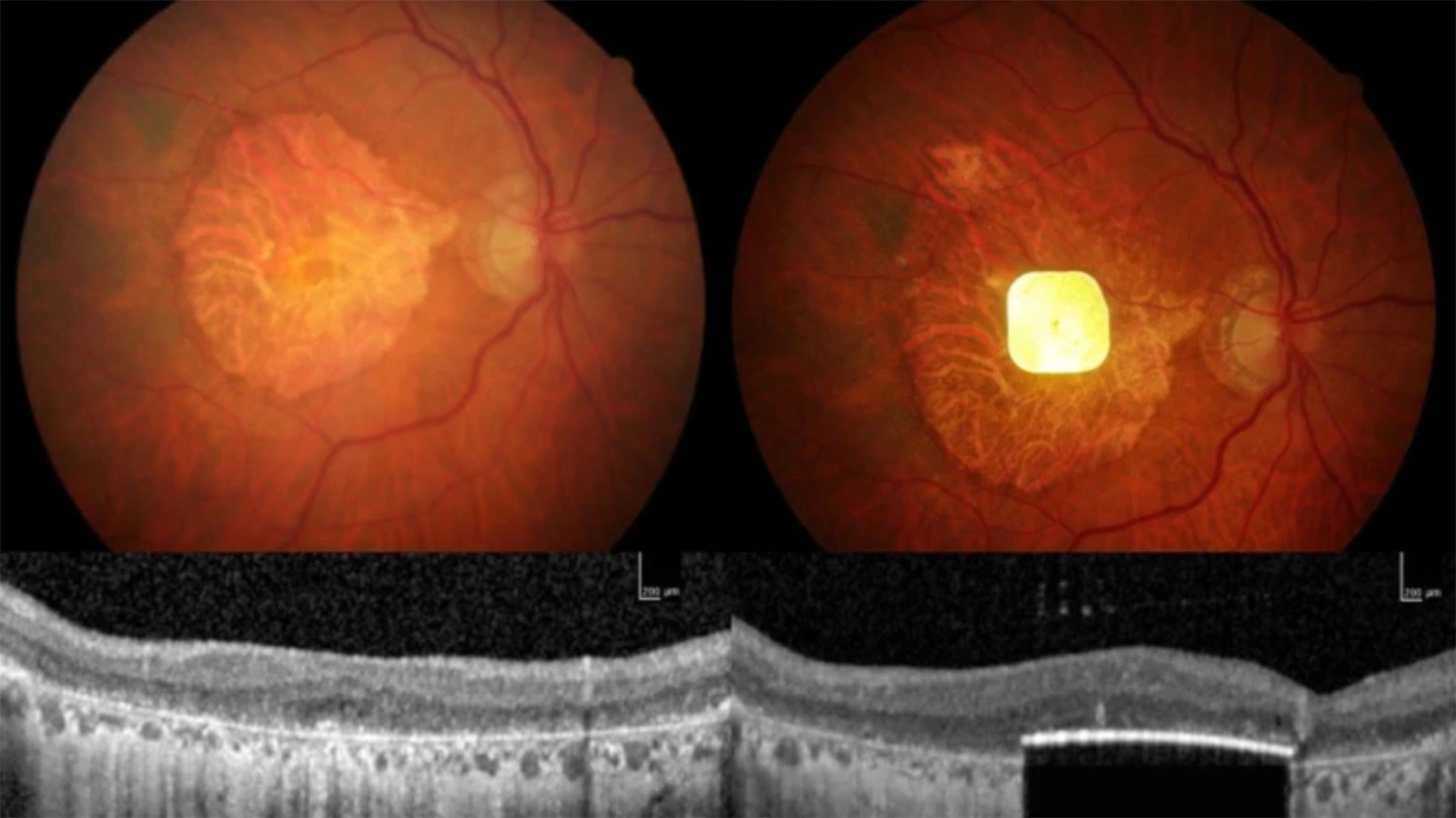 Глазной имплантат с искусственным интеллектом