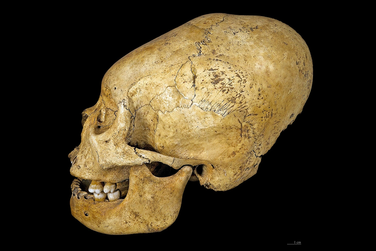 Деформированный череп из культуры прото-Наска (доколумбовая цивилизация), 200–100 годы до н.э